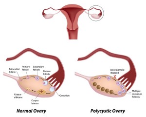 polycystic ovary syndrome infertility